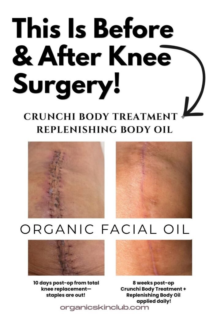 Best organic body oil results: knee replacement scar before and after using Crunchi body care